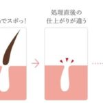 ヒゲ脱毛の利用者が年々増加